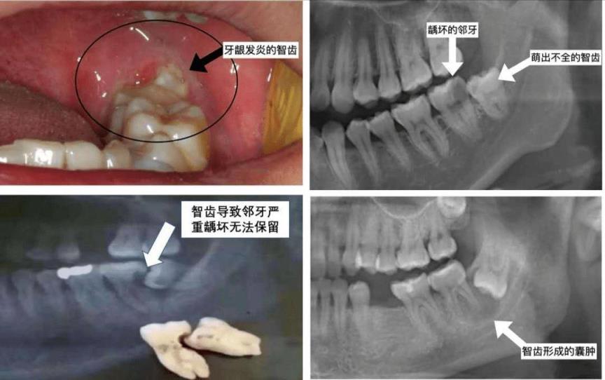 口腔医院拔智齿多少钱(中医讲拔智齿是愚蠢的行为)